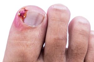 17664-ingrown-toenail