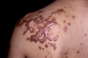 Keloid_shoulder_scar_SPL22-e1650985284813