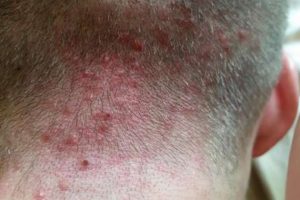 folliculitis-680x380
