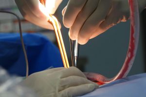 Free stock photo of anesthesia, blood loss, complications